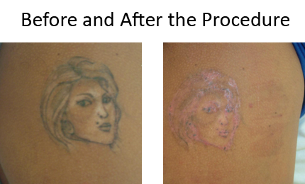 Laser Tatto Removal on Laser Tattoo Removal