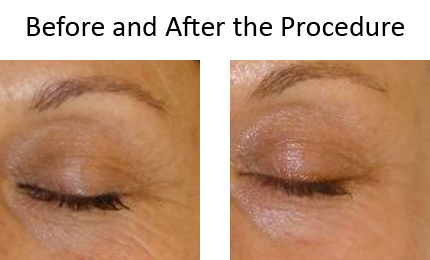 skin rejuvenation laser photo rejuvenation laser hair removal acne 