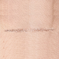 Post Surgical Scar