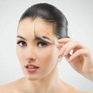 acne scars treatment dubai
